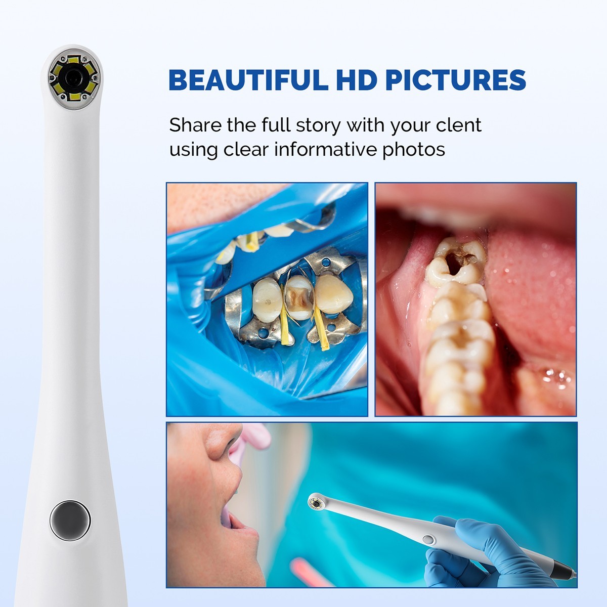 AZDENT Dental HD Intraoral Camera USB Digital Imaging Work on Dexis/Eaglesoft