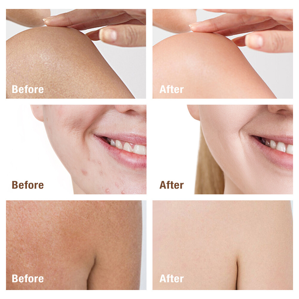 Kojic Acid Soap Dark Skin Whitening Bleaching Lightening Brightening Face & Body