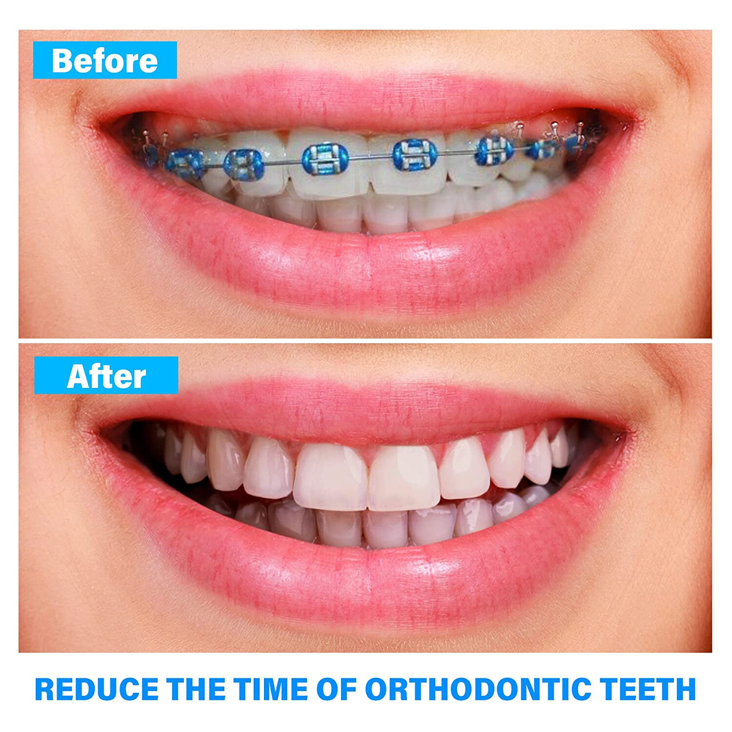 1040pc Orthodontic Ligature Ties Elastic Ligas Ortodoncia Rubber Bands Brackets