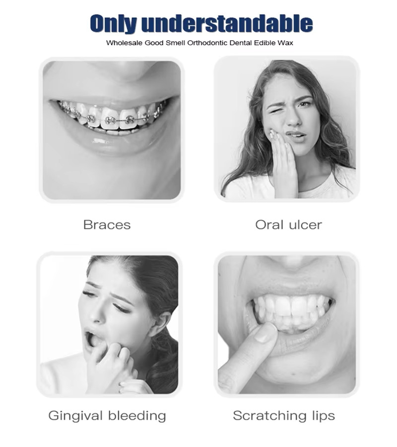 50/100Pks 10 Fruit Scent Dental Orthodontics Ortho Wax For Braces Gum Irritation