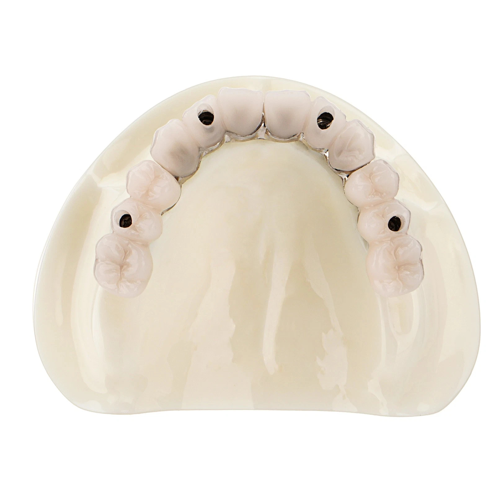 Dental All-on-4 Overdenture Model Dental Upper Jaw Implants Restoration 4 Screws