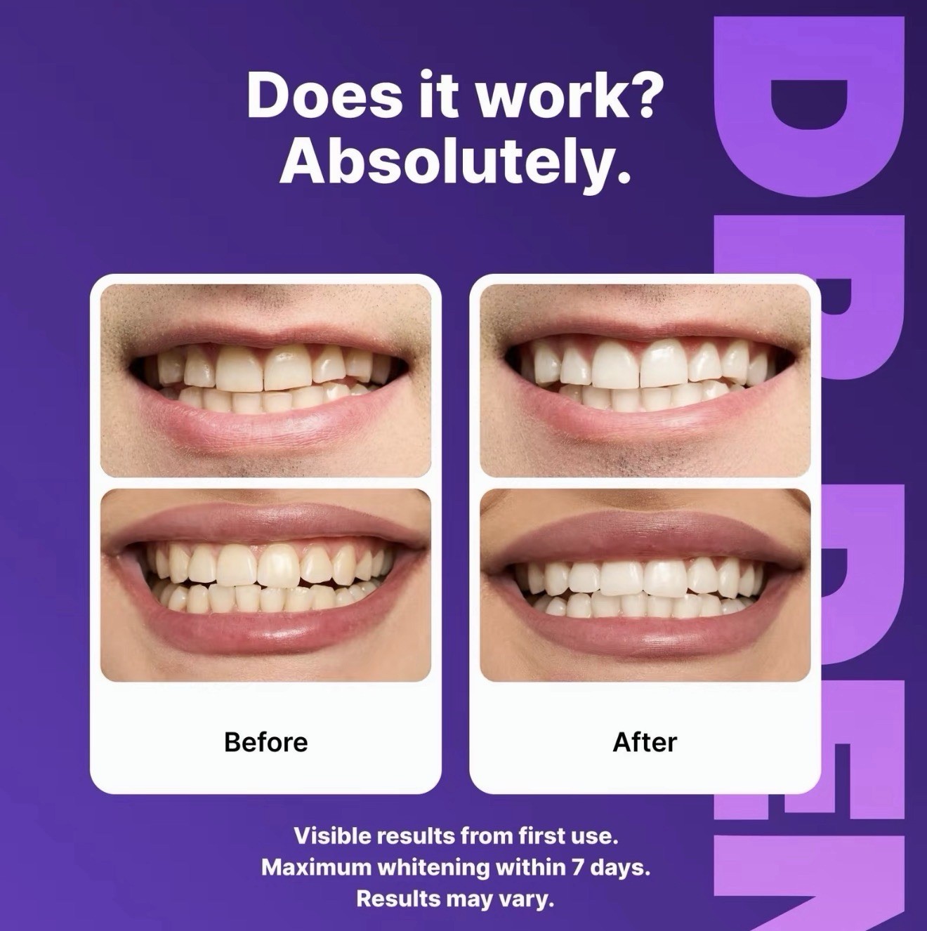 DRDENT Purple Whitening Strips: 14 strips, Enamel-Safe, Peroxide-Free Teeth