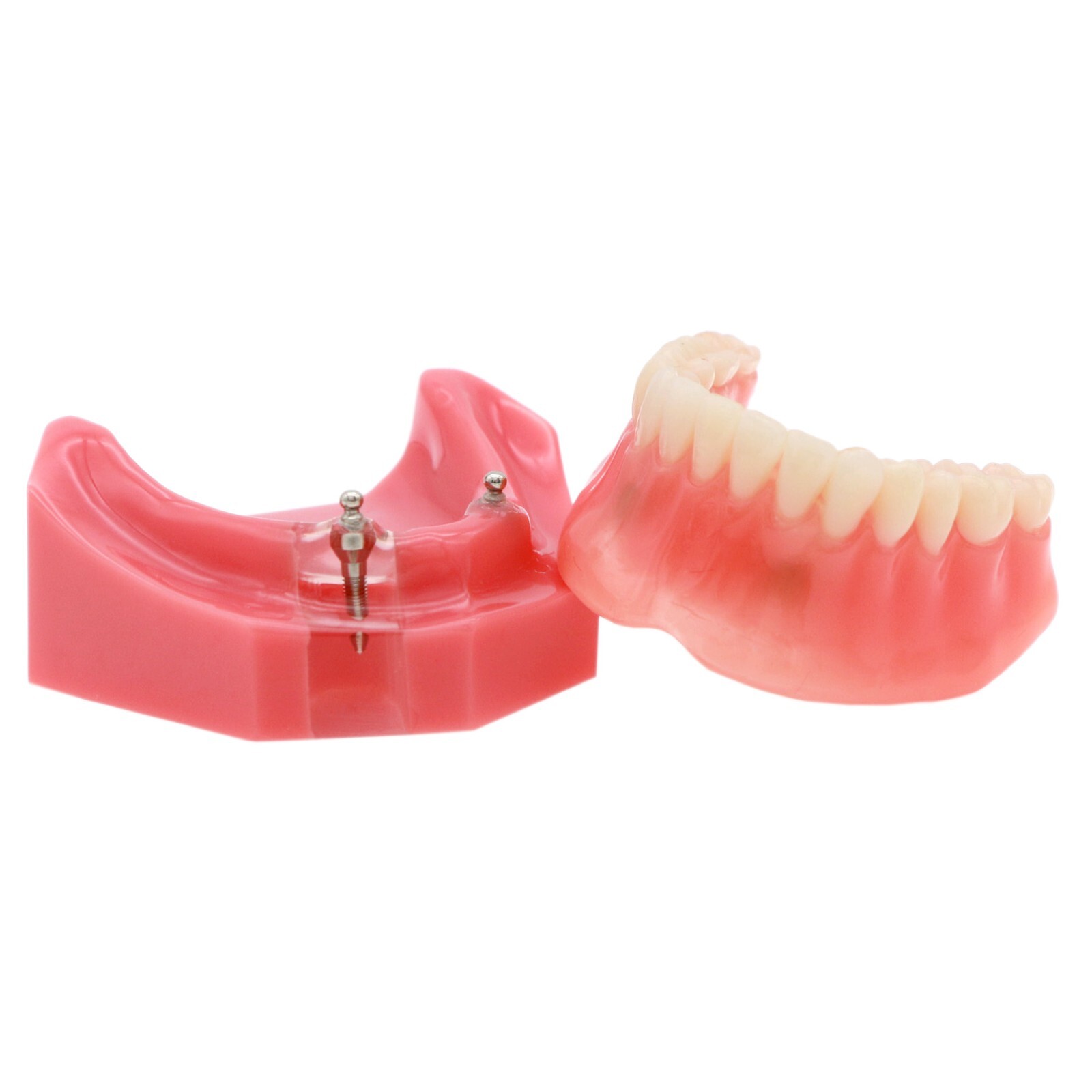 Dental Implant Typodont Teeth Restoration Model Series Overdenture Practice Demo
