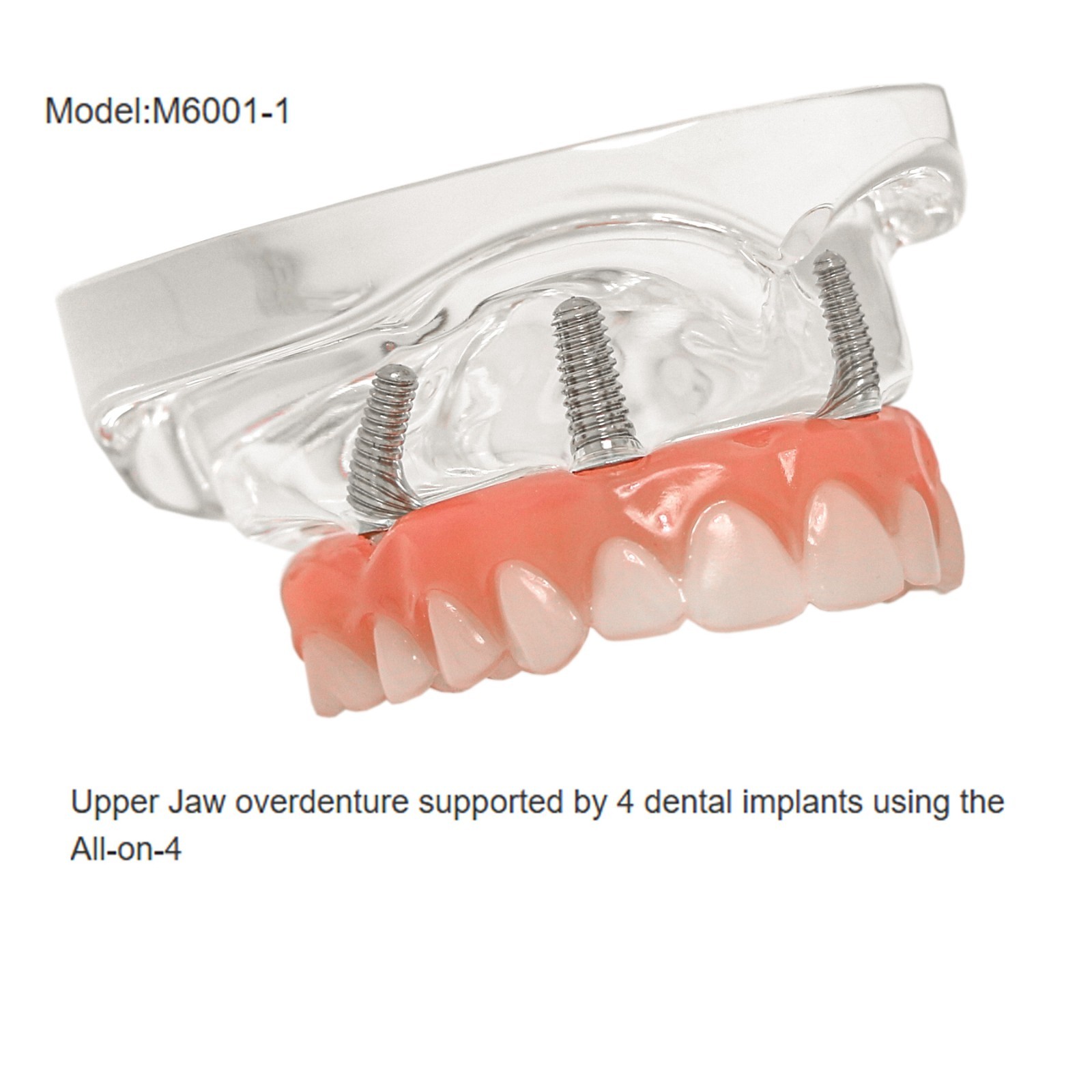 Implant Overdenture Al-on-4 treatment concept Demo Teeth Model Upper/4Srew Clear
