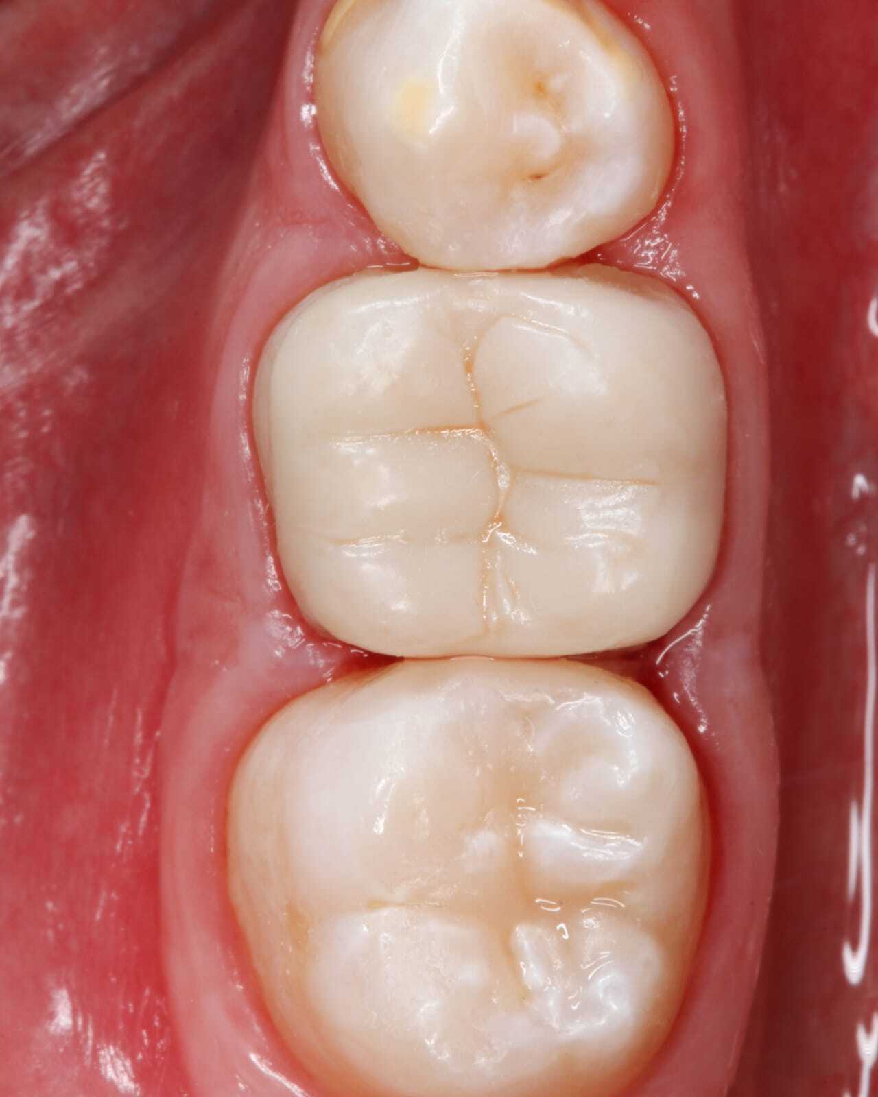 DLP SLA LCD 3d printer permenant crown - teeth resin ..