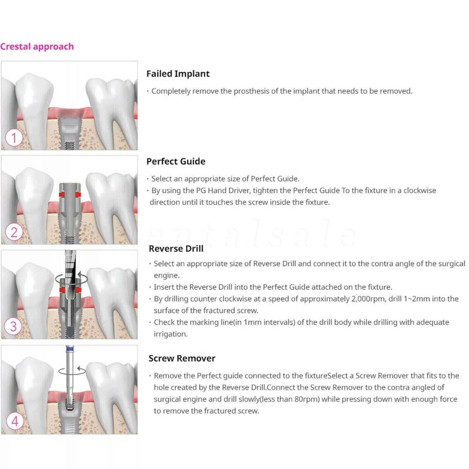 Dental Implant Fixture & Broken Screw Removal Kit Remove Surgical Tool Remover