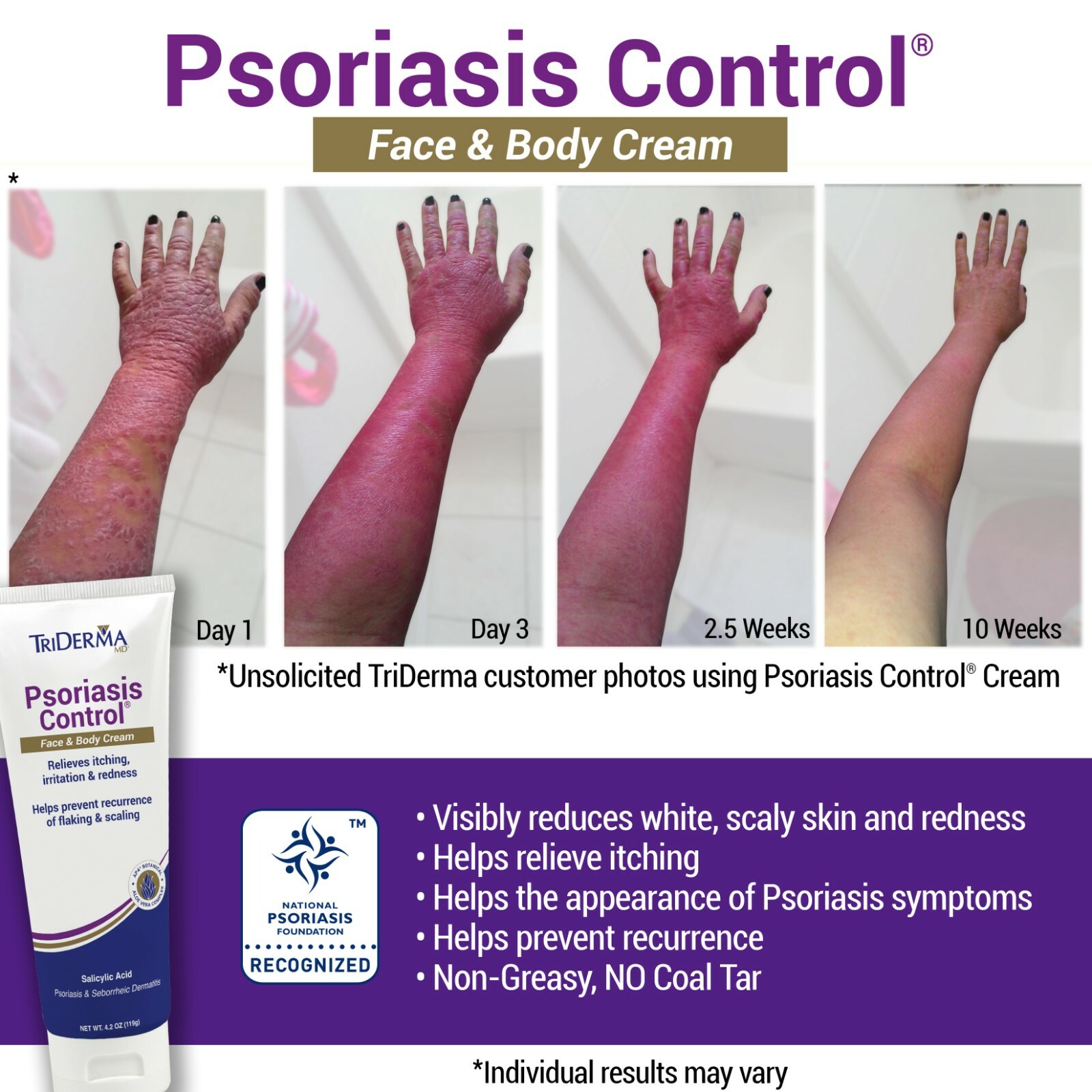 TriDerma Psoriasis Control Face and Body Cream, Cortisone-Free 4.2 Ounces