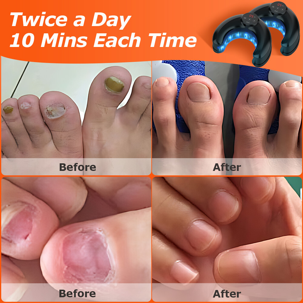 Toenail Fungus Laser Device Nail Repair Solution Toenail Fungus Laser Device