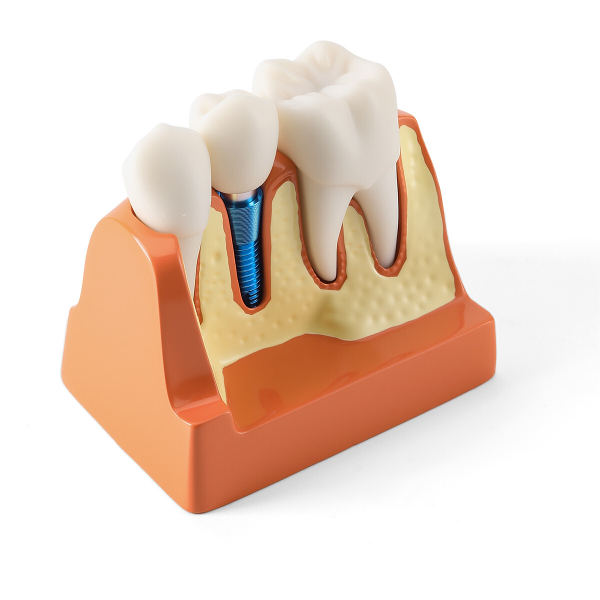 4 Times Dental Teeth Removable Model Implant Teaching Learning Tool Analysis