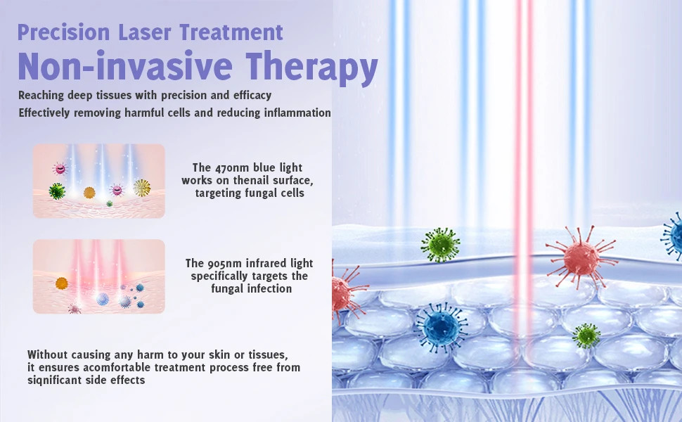 Nail Fungus Treatment Toe Nails Toenail Fungus Remover Toenail Laser Device