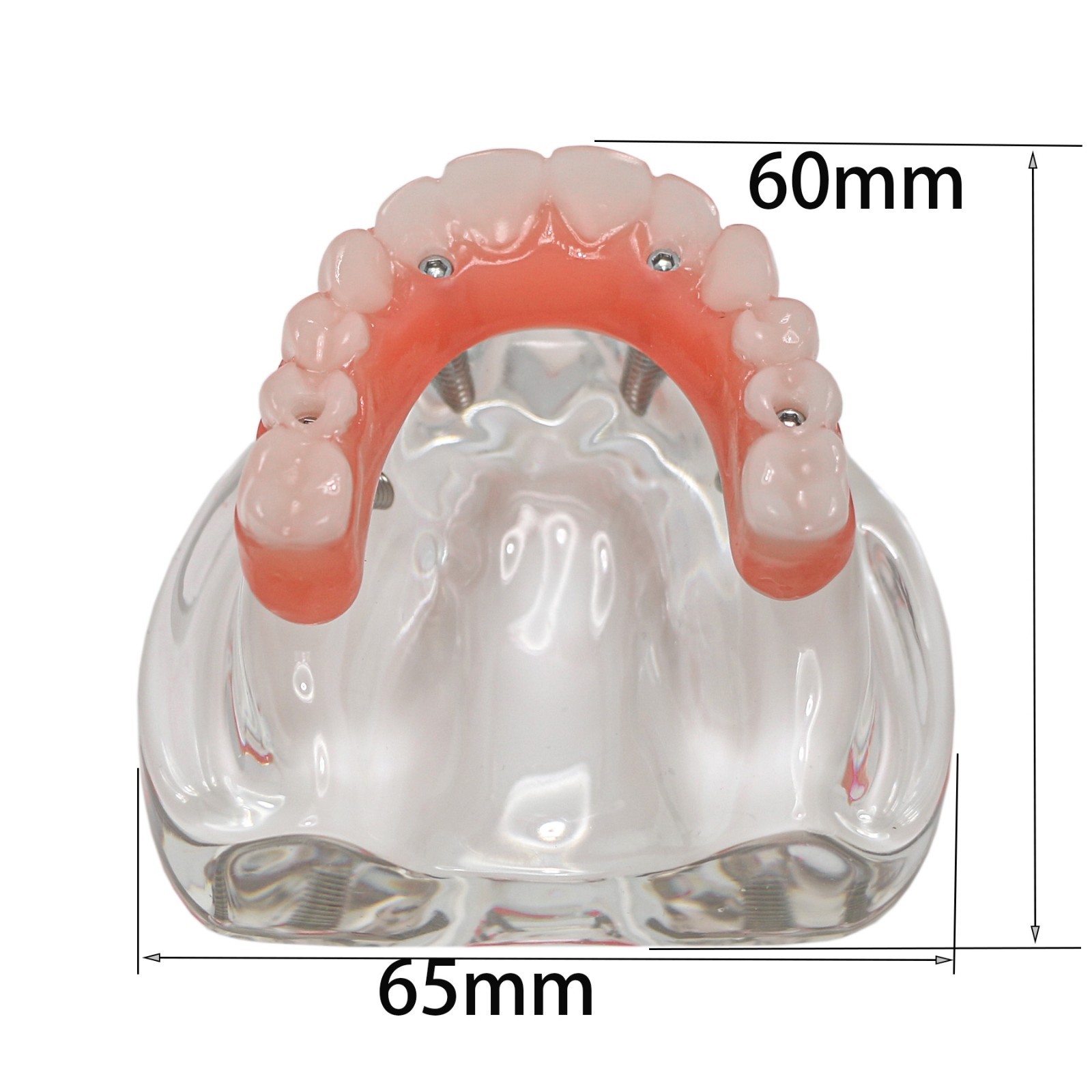 Implant Overdenture Al-on-4 treatment concept Demo Teeth Model Upper/4Srew Clear