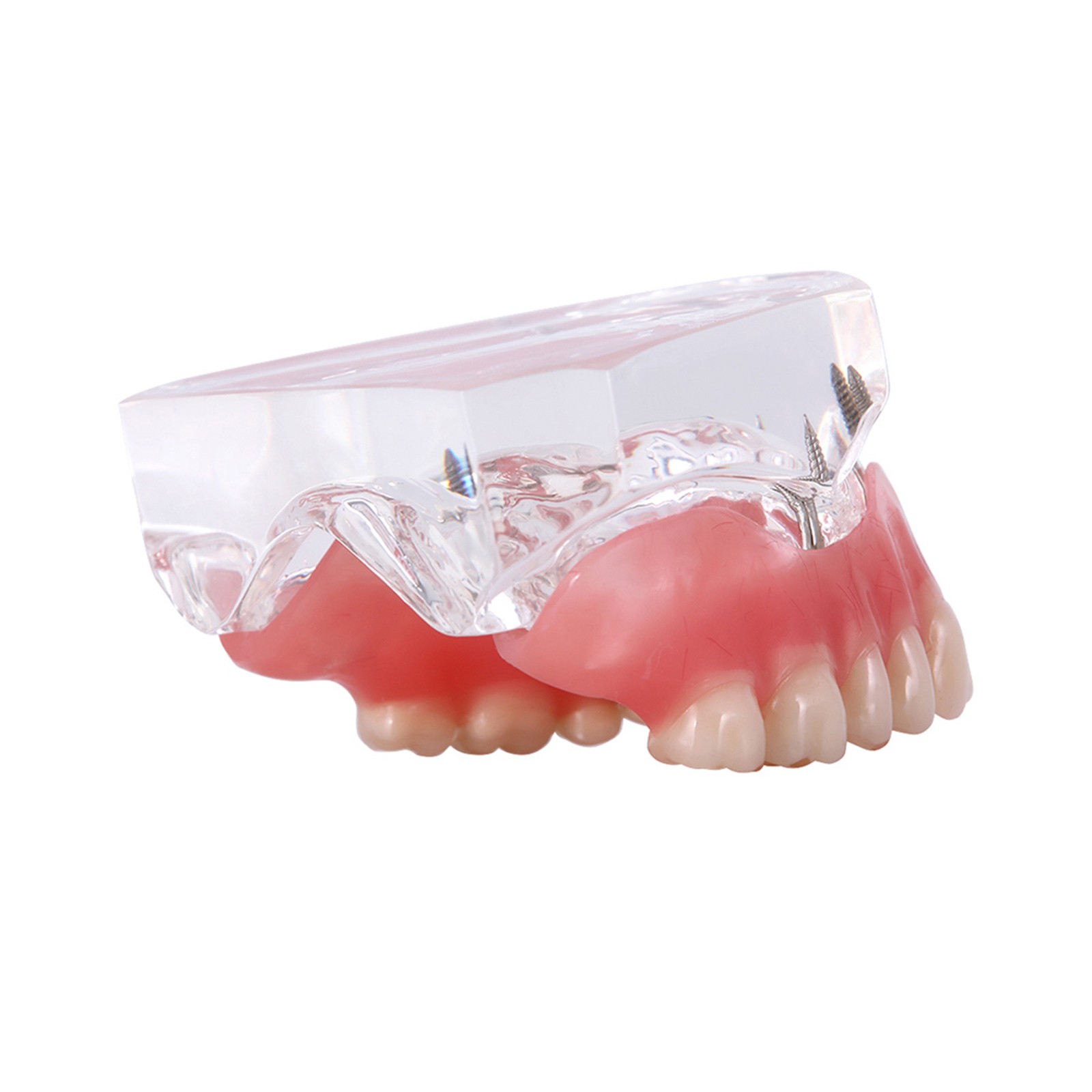 US Dental Removable Overdenture Teeth Model 4 lmplants Restoration Demo Clear
