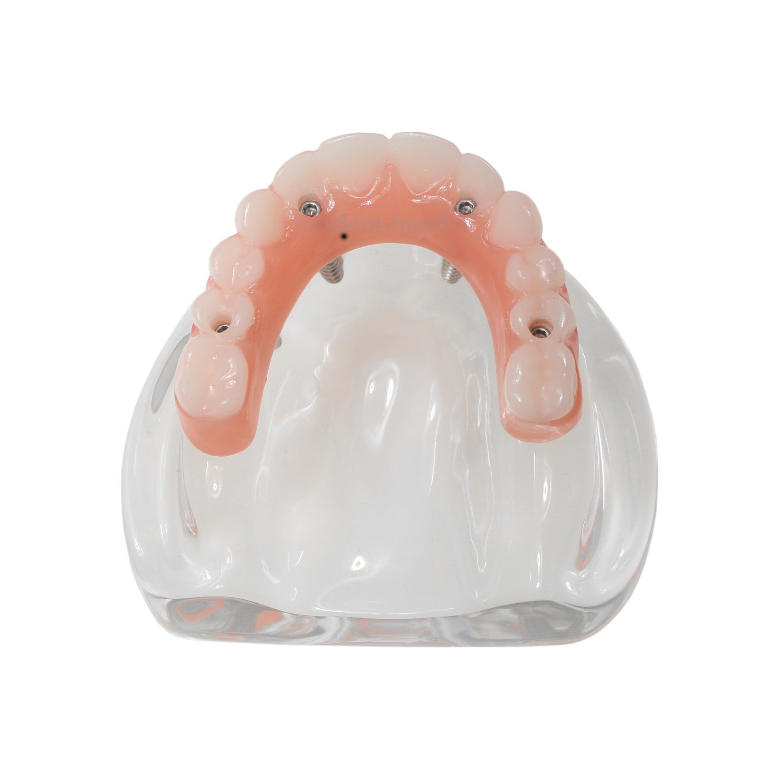 Dental Upper/Lower 4 Implants Demo Implant Teeth Model Restoration Overdenture