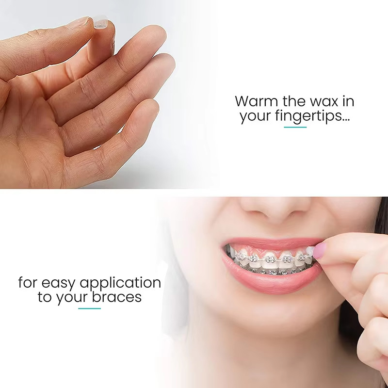 50/100Pks 10 Fruit Scent Dental Orthodontics Ortho Wax For Braces Gum Irritation