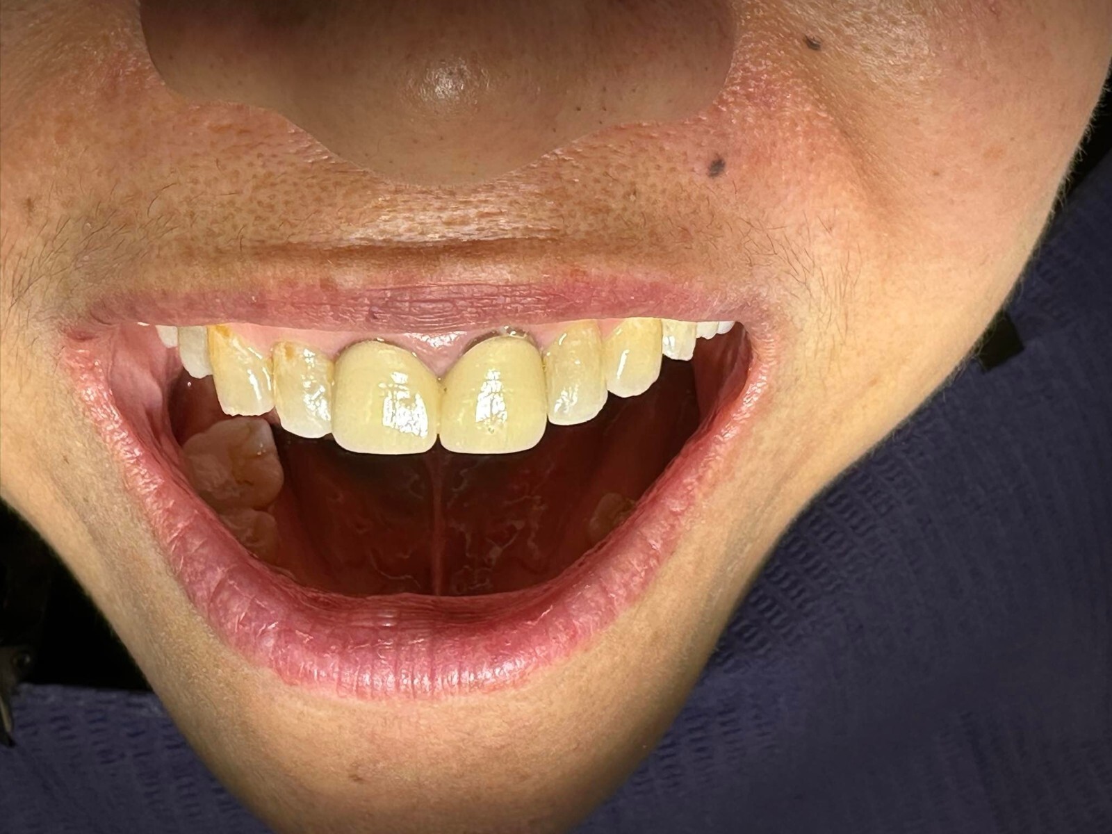 DLP SLA LCD 3d printer permenant crown - teeth resin ..