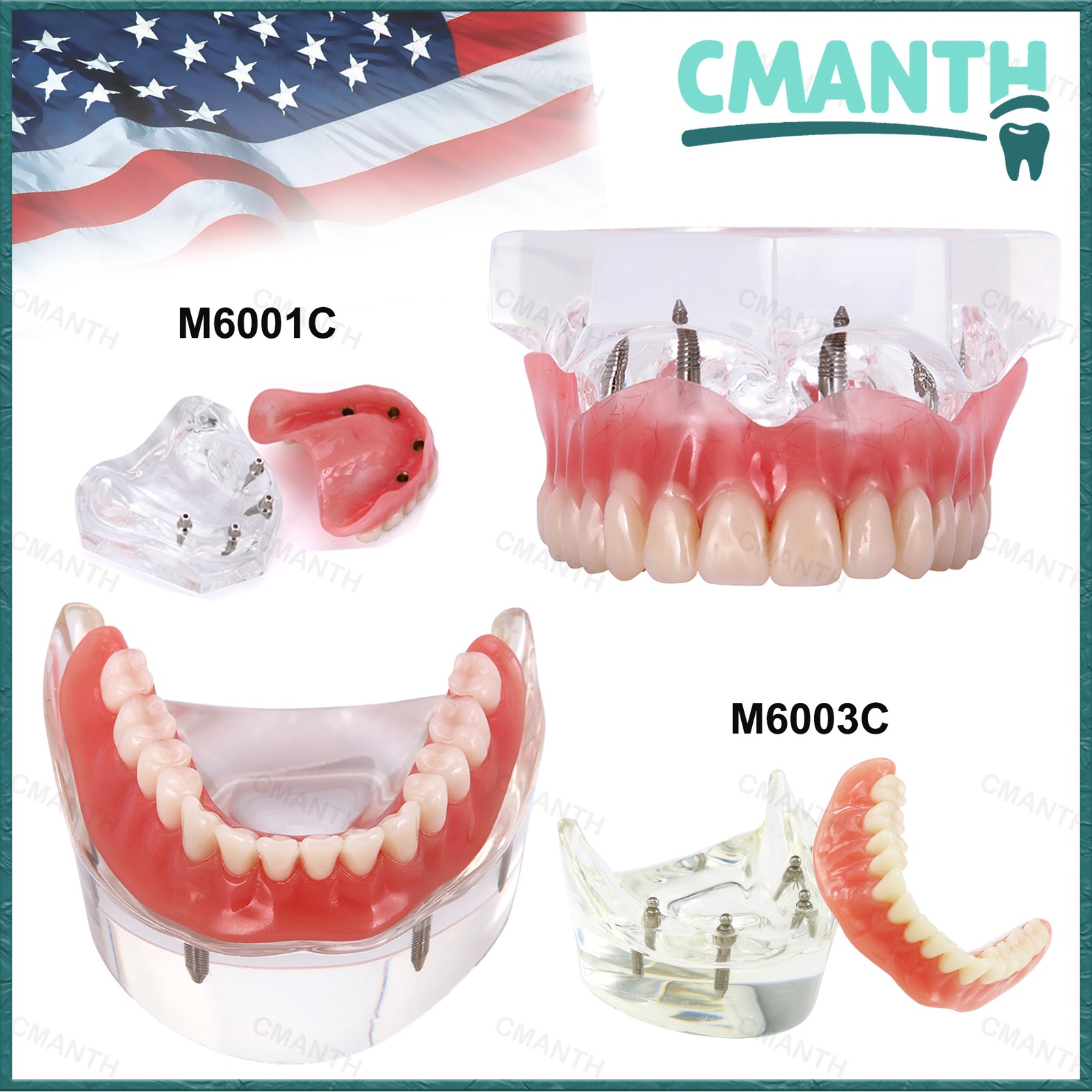 US Dental Removable Overdenture Teeth Model 4 lmplants Restoration Demo Clear