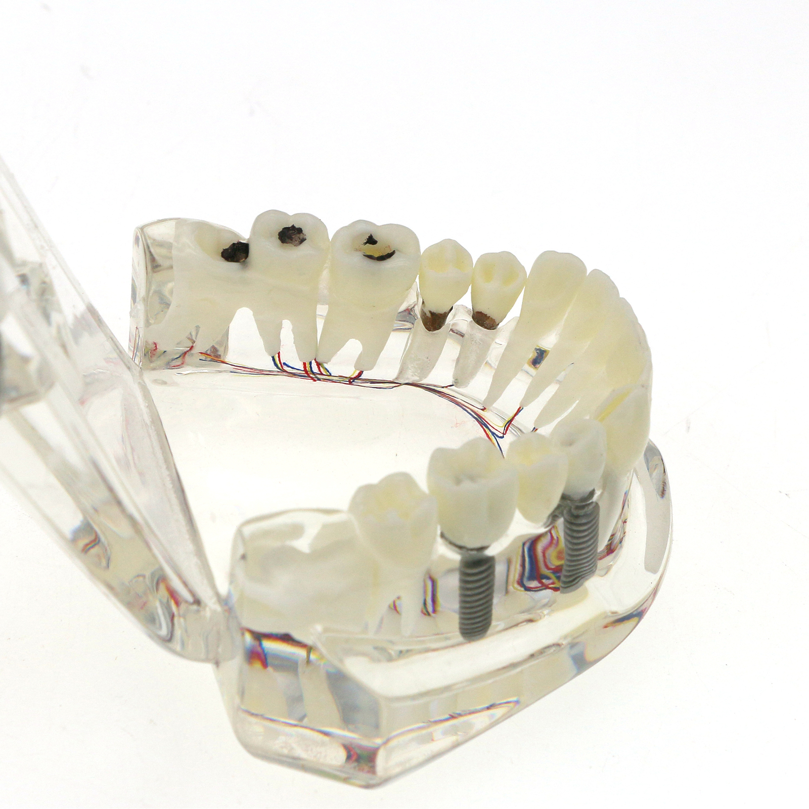 Dental Oral Typodont Model Implant Pathological Teaching Standard Size (Clear)
