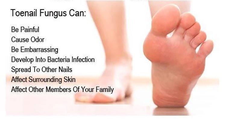 Nail Fungus Treatment For Toe and Finger Nail Fungal Infections #1 Natural Cure