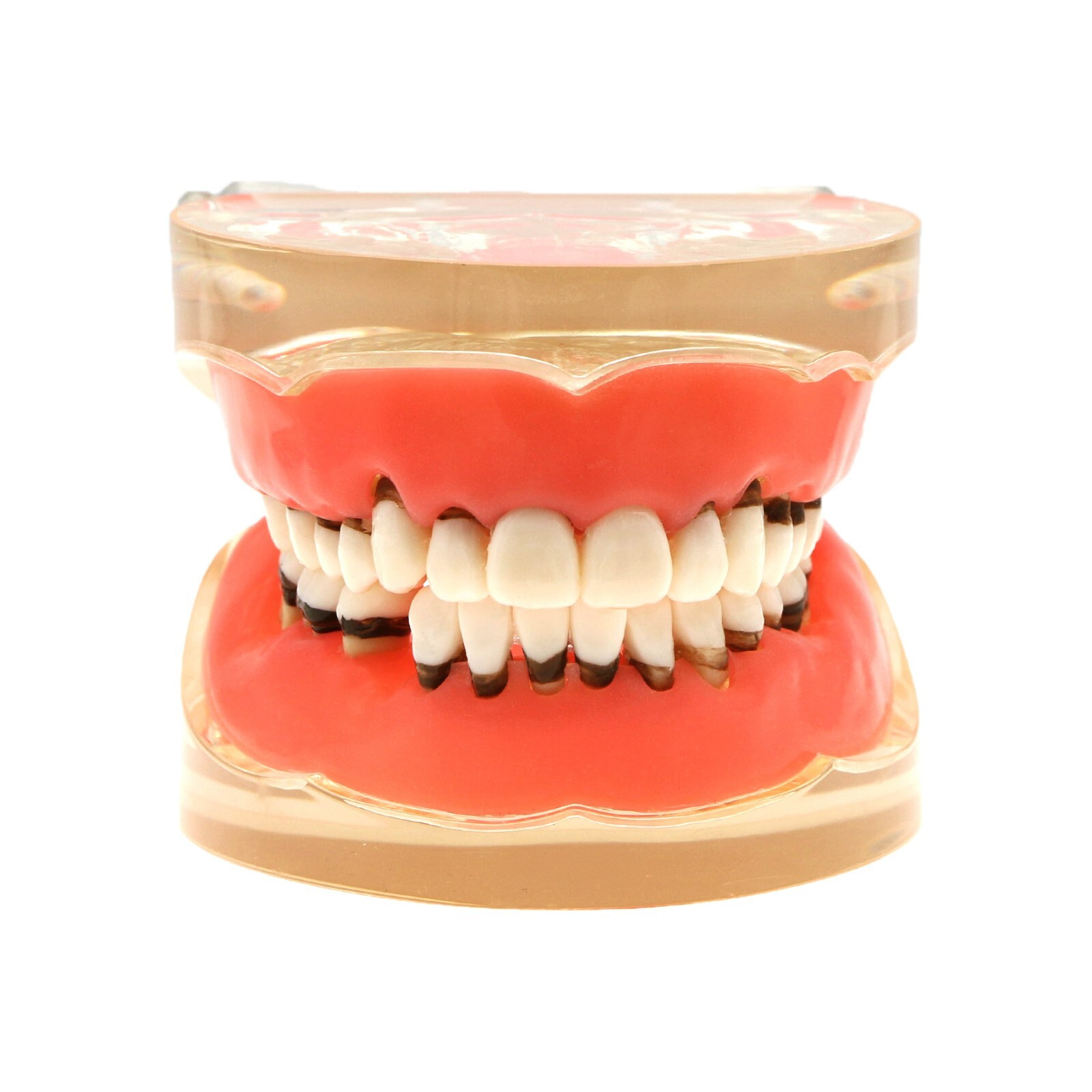 Dental Adult Periodontal Disease Pathological Teeth Typodont Model Removable Gum