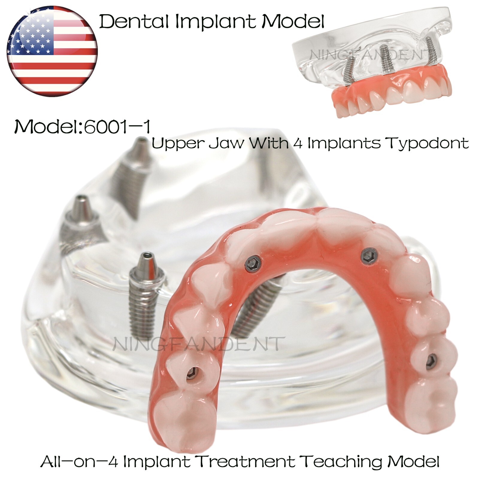 US Dental All-on-4 Overdenture treatment Implant Model Upper 4 Implants Clear