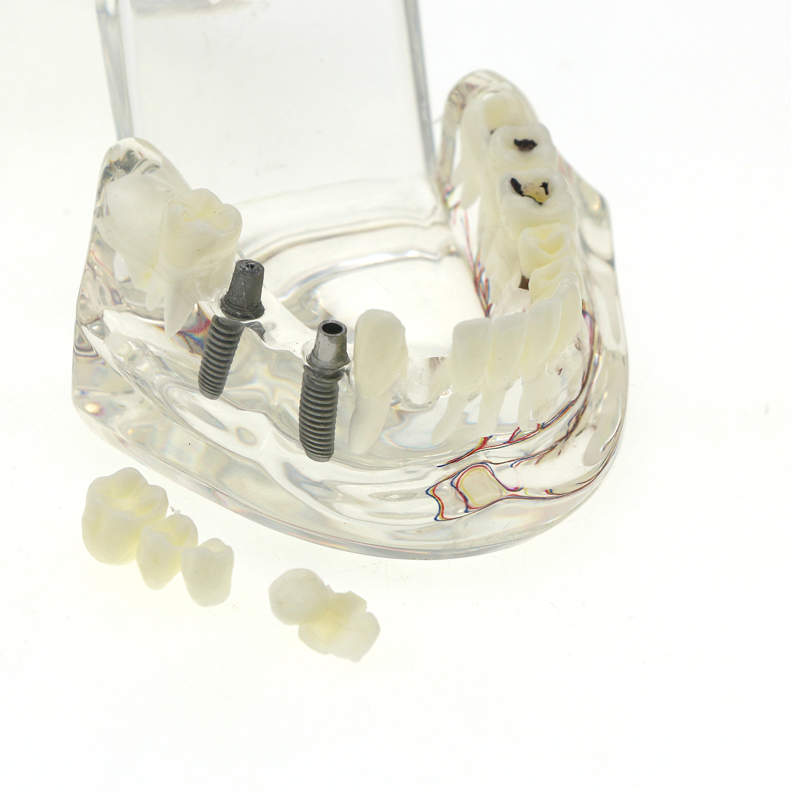 Dental Oral Typodont Model Implant Pathological Teaching Standard Size (Clear)