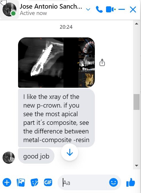 DLP SLA LCD 3d printer permenant crown - teeth resin ..