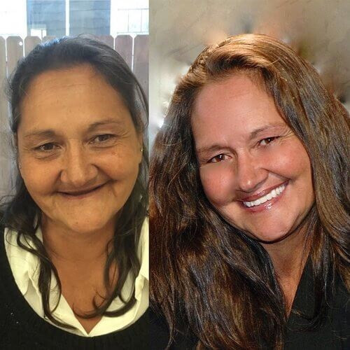 DIY DENTURE KIT Complete Custom Dentures Temporary Teeth Tooth * FULL /PARTIAL*