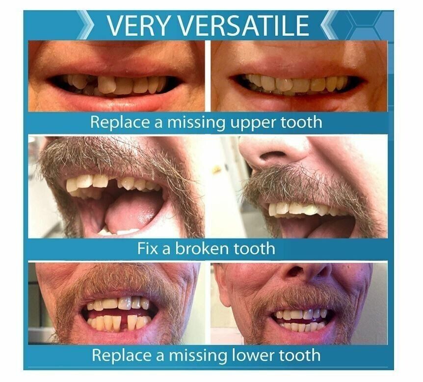 Instant Smile Multi-Shade Temporary Tooth Repair Kit 3 SHADES-Rapid Repair