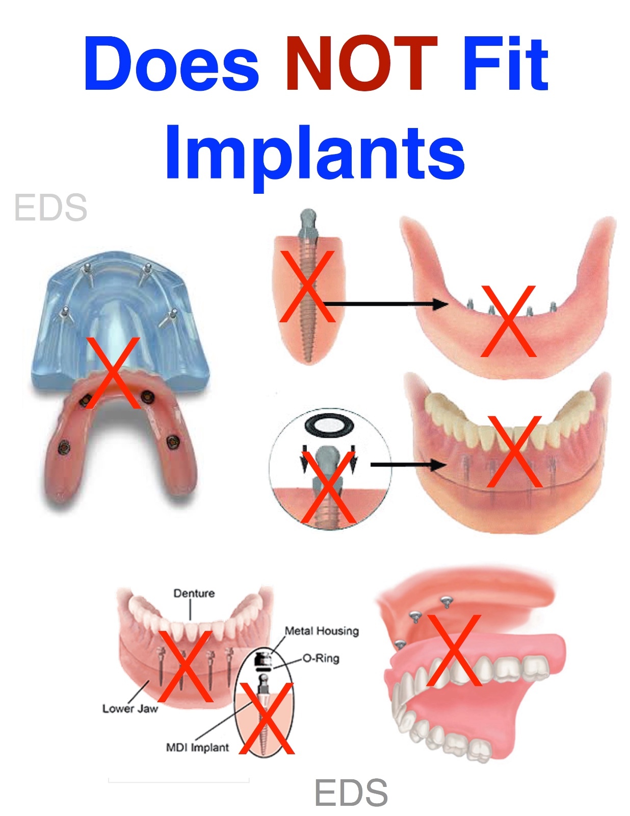 O-Ring Replacement Kit for Scaler Inserts Tips- (Green Kit Only)