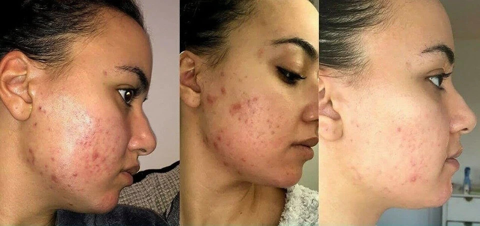 Retinol Gel 0.1 Vitamin a Repairs Fine Lines & Wrinkles, Scar Treatment, Age 20g