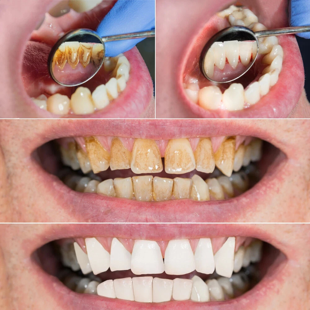 Electric Tooth Cleaner Dental Tools Plaque Calculus Remover Teeth Cleaning Kits