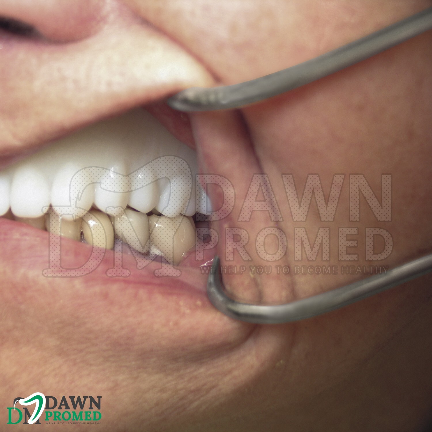 2 Pcs Columbia Lip & Cheek Retractor 5.5" Dental Mouth Opener Orthodontic Inst