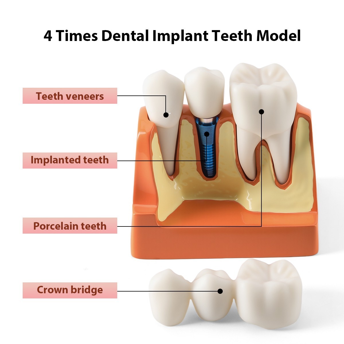 Dental 4 Times Teeth Model Implant Analysis Crown Bridge Demonstration Removable