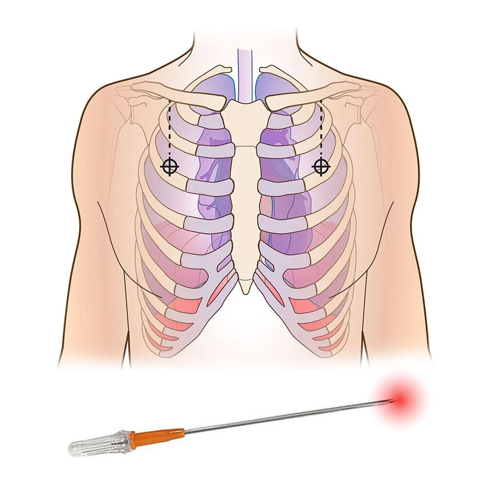 2pcs Rescue Tension Pneumothorax Needle Chest Decompression EDC First Aid 14G