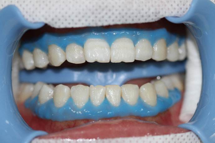 5PC*3ml Dental Gingival Barrier Gel Tooth Dam Barrier Gel Gum Protector Syringe