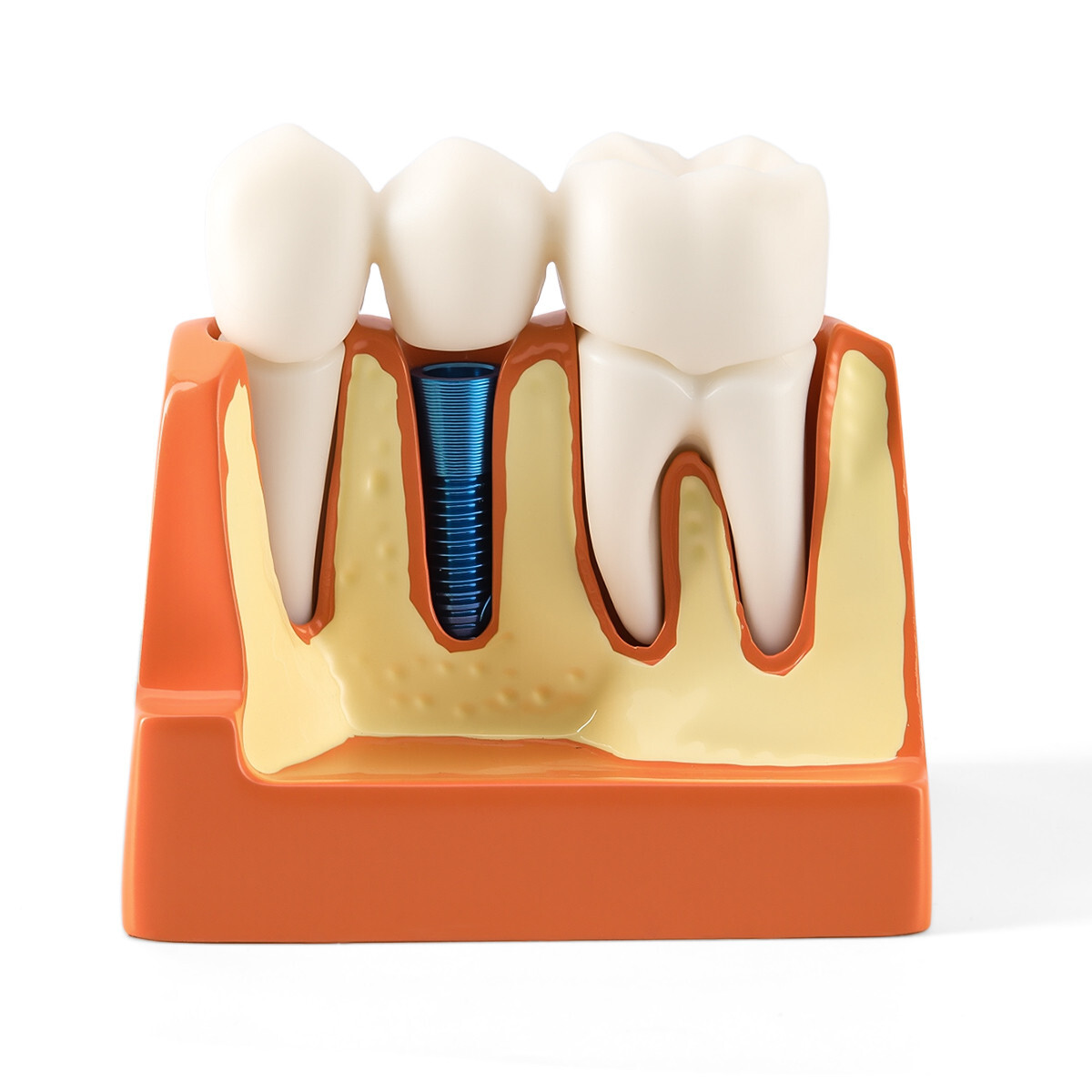 4 Times Dental Teeth Removable Model Implant Teaching Learning Tool Analysis