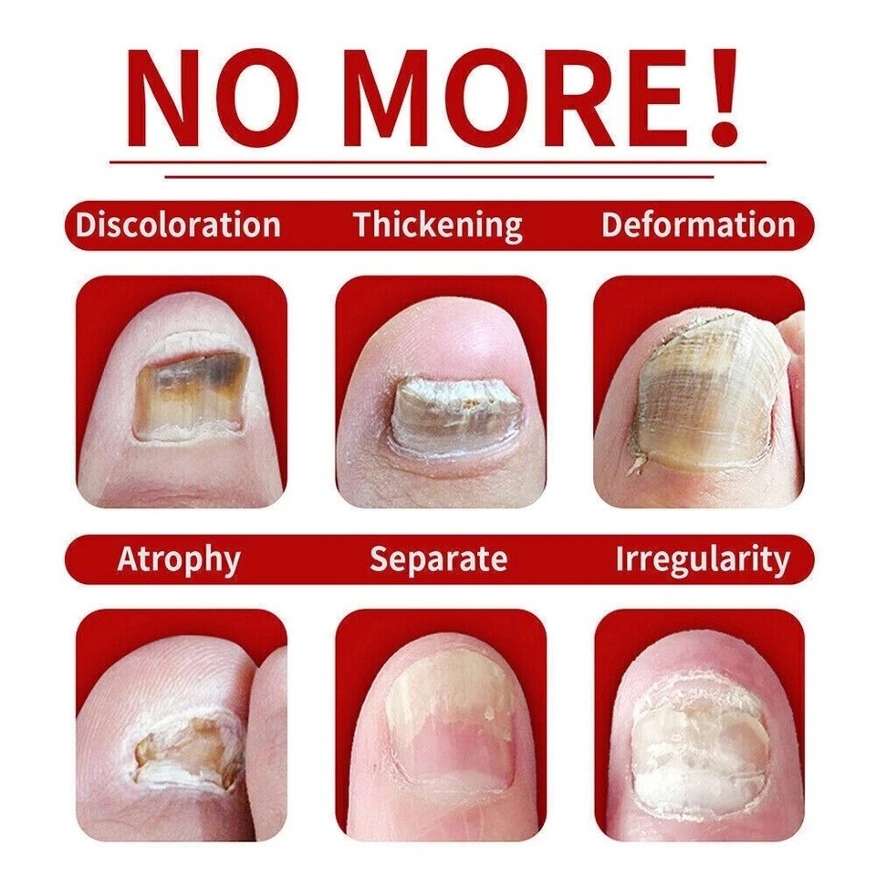 Nail Fungus Laser Nail Fungus Cleaning LED Light Device for Multiple Toenail US