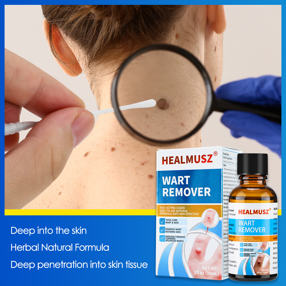 Wart Remover Liquid Skin Tag Mole Remover Eliminate Feet Corn Wart Remove Liquid