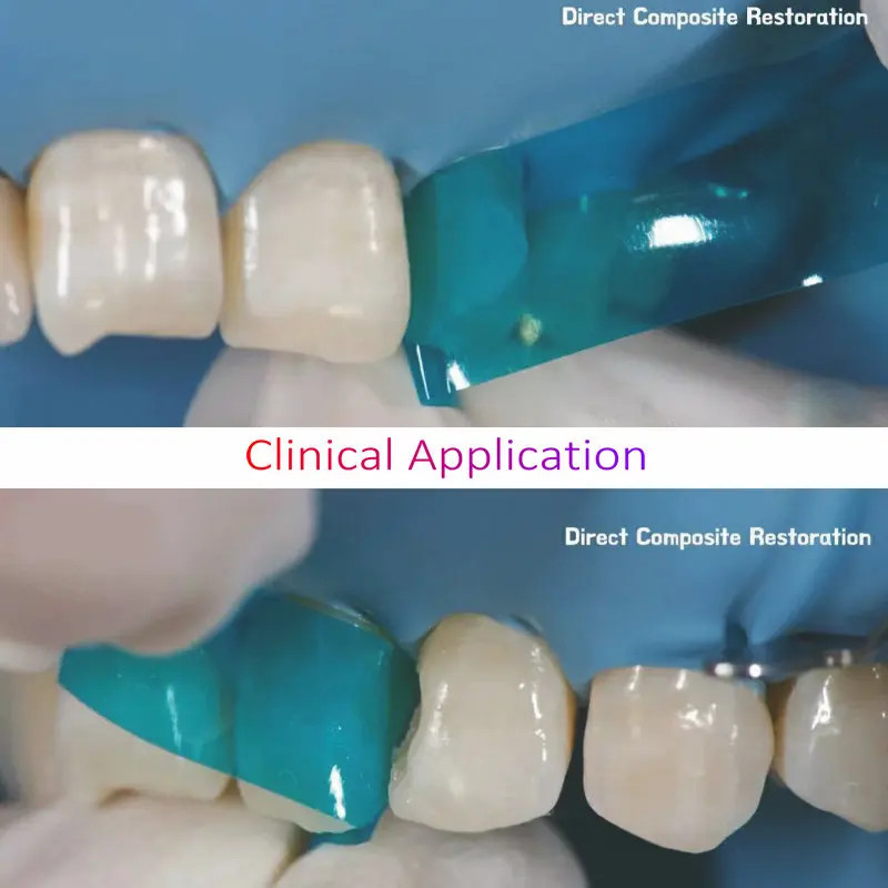 Dental Contoured Anterior Matrix Bands Polyester Anterior Strips Matrices System