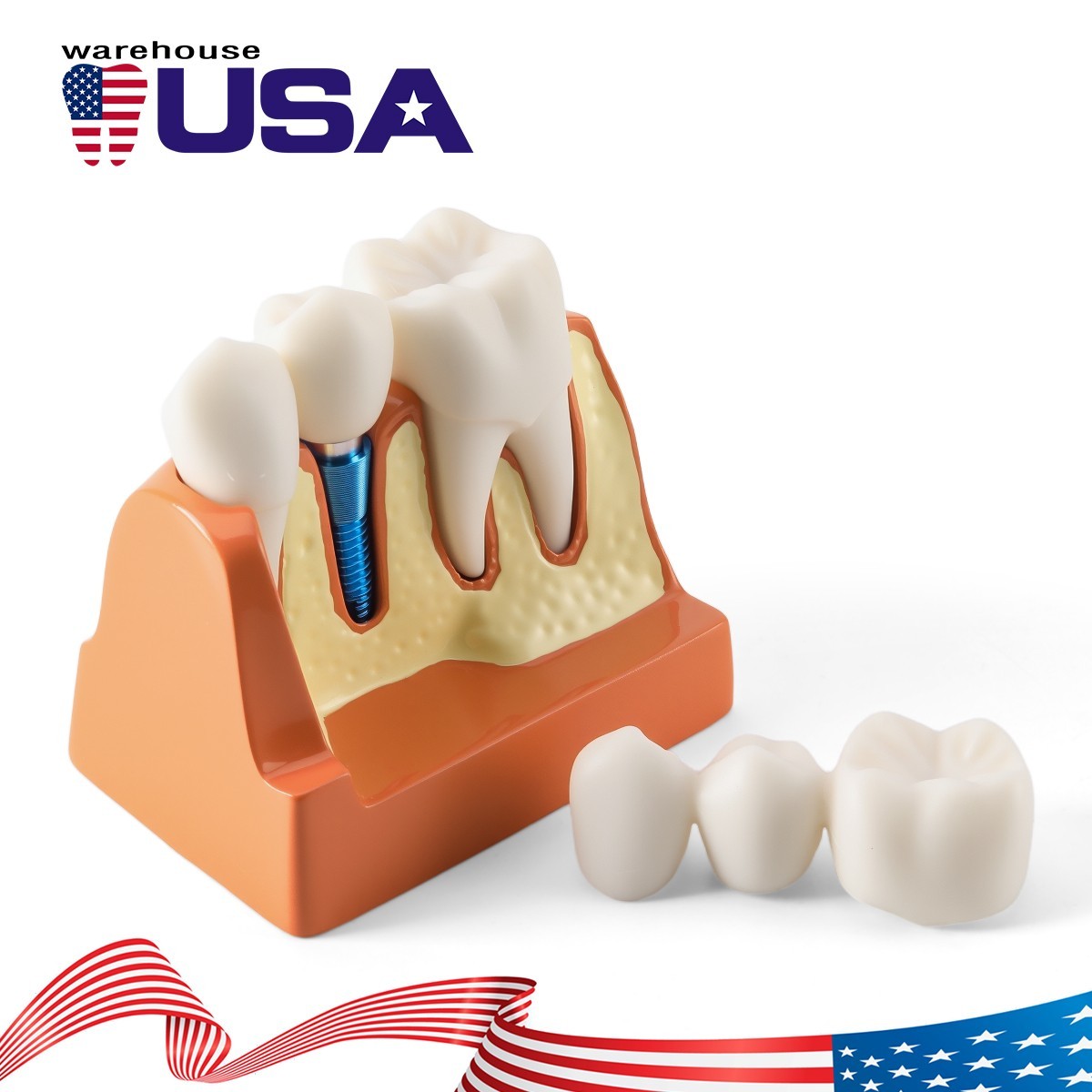 Dental 4 Times Teeth Model Implant Analysis Crown Bridge Demonstration Removable