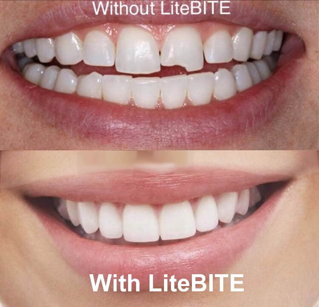 LiteBITE Mouthguard for Basketball, Hockey, Lacrosse, Sports, with Carry Case!