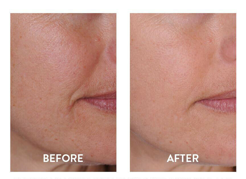 HYALURONIC ACID 100% Pure Anti Aging Hydrating Serum, Plumps Wrinkles Fine Lines