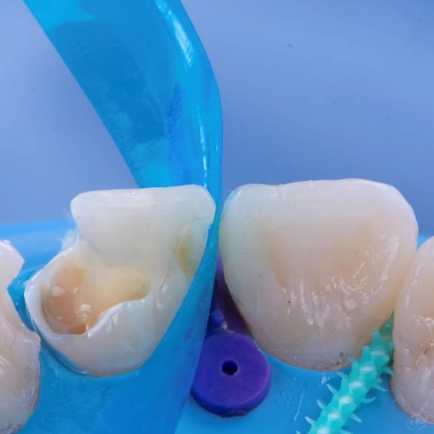 Dental Contoured Anterior Matrix Bands Polyester Anterior Strips Matrices System