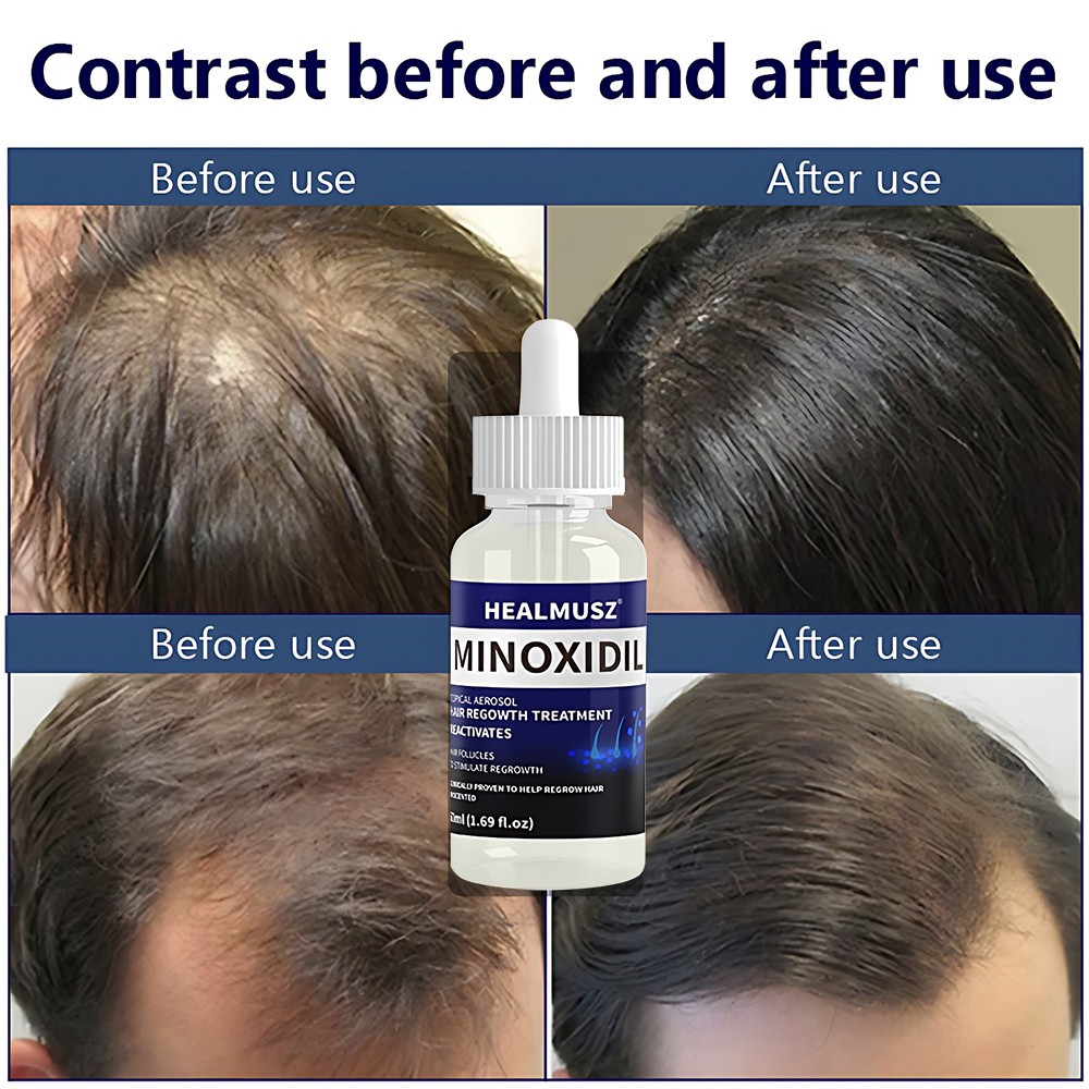 2 Pack Minoxidil 5% Extra Strength Men Hair Regrowth Treatment 2 Month Supply