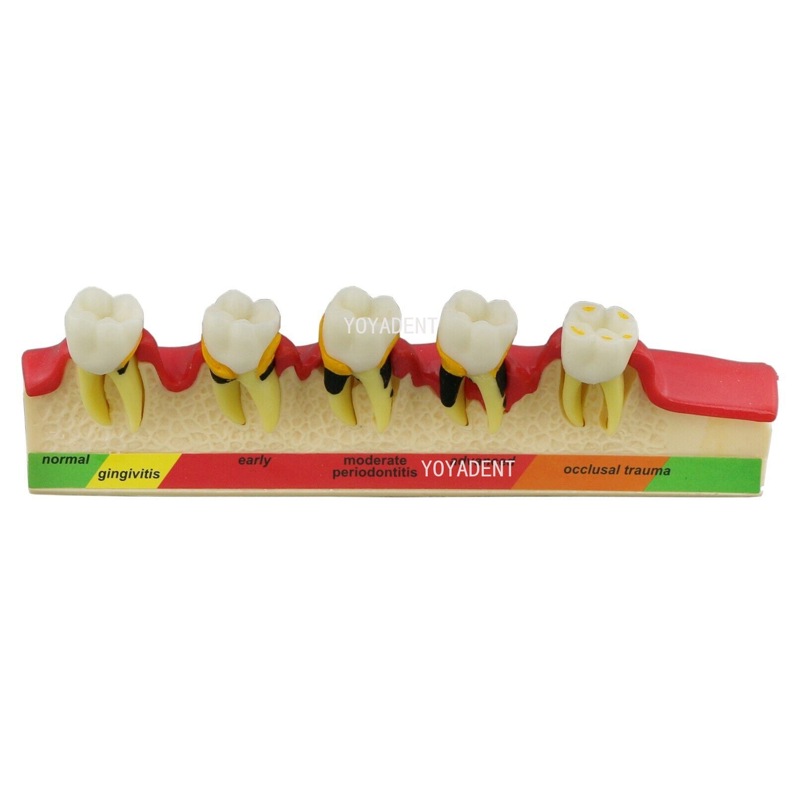 Dental Model Periodontal Disease Assort Teeth Model Endodontic Teaching Demo US