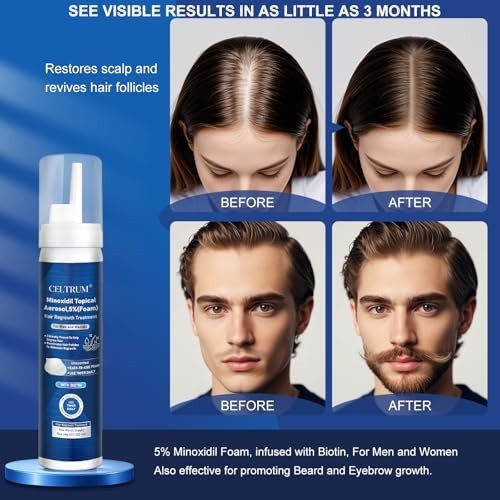 5% Topical Minoxidil Foam, Minoxidil for Men and Women, Infused with Biotin