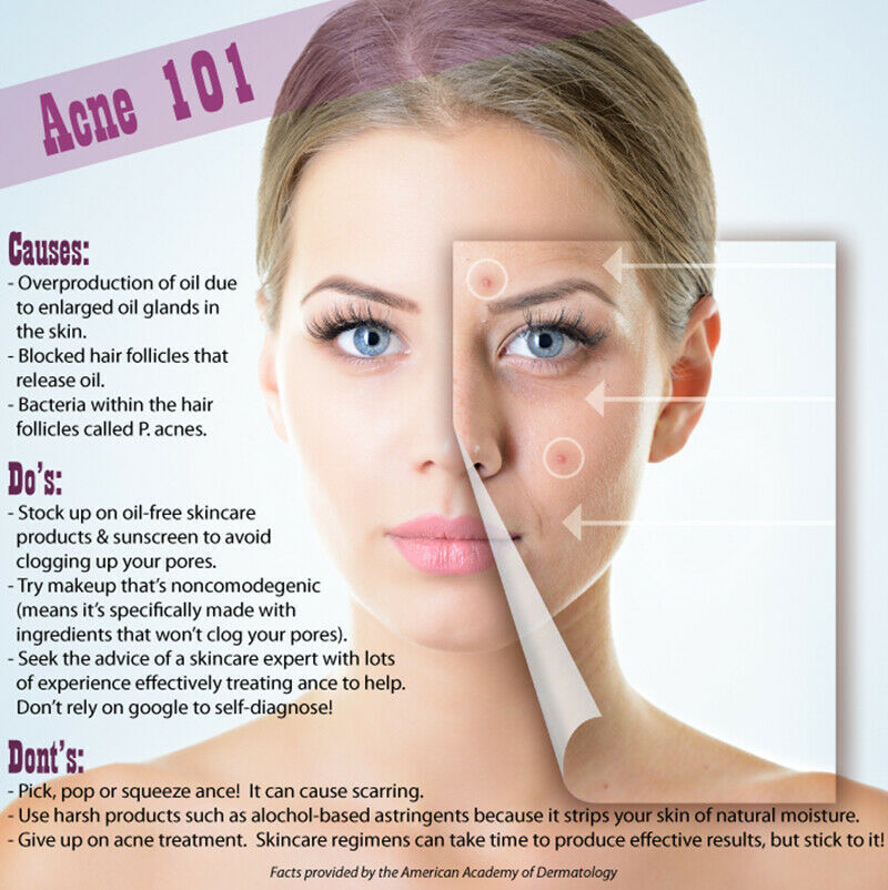 Lactic Acid Skin Peel For Acne Wrinkles Melasma Age Spots 25% 40% 50% 90%