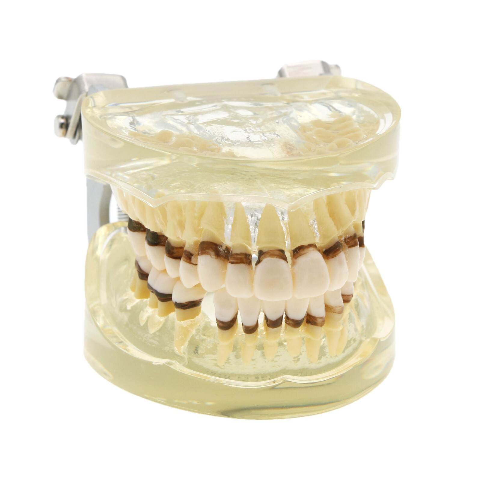 Dental Adult Periodontal Disease Pathological Teeth Typodont Model Removable Gum