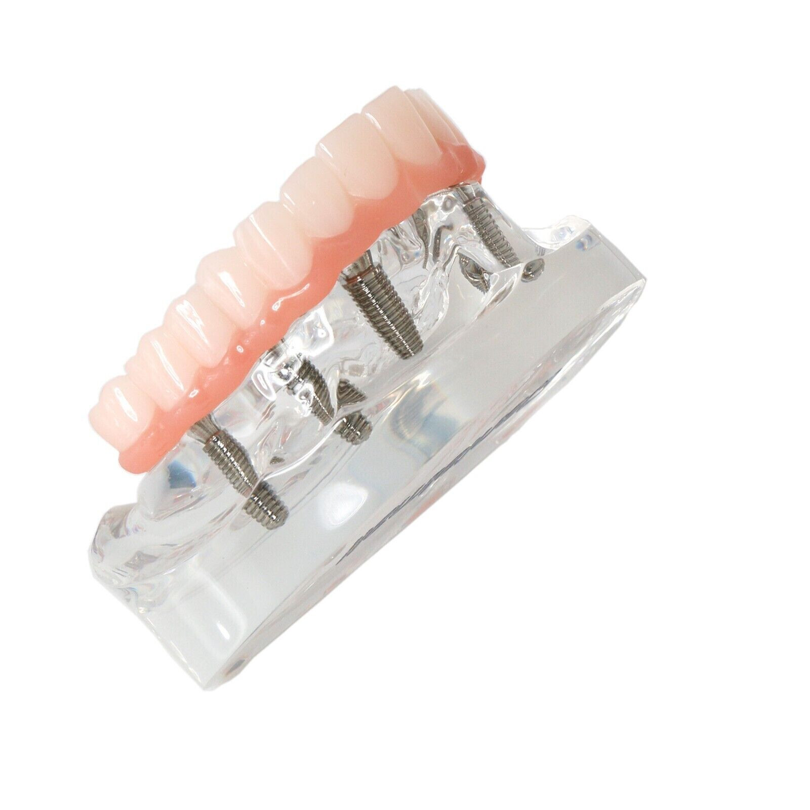 Dental All-On-6 Overdenture Implant Model Demo Upper Jaw 6 Screws Clear M6001-2