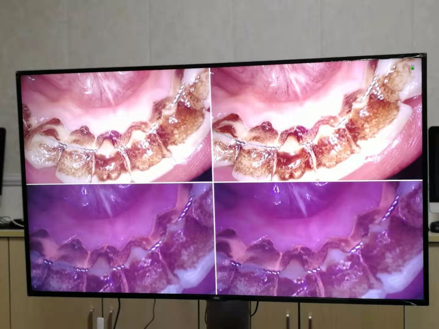 New 1080P Intraoral Camera For Decayed Tooth/Dental Calculas And Plaque MD4000B